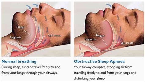 sleep apnea avenue dental