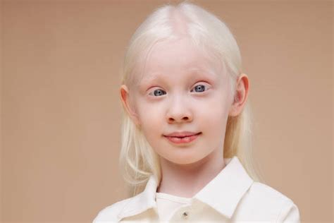Albinism Baby Stock Photos Pictures And Royalty Free Images Istock