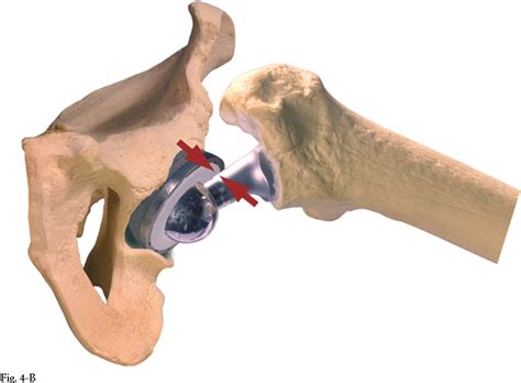 Figure 4 From Impingement With Total Hip Replacement Semantic Scholar