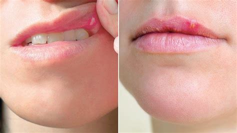 Cold Sores Vs Canker Sores Whats The Difference Everyday Health