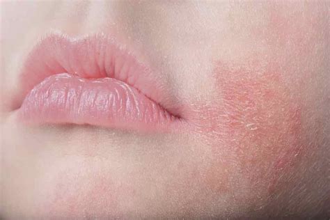 Dermatitis Perioral Gejala Penyebab Dan Pengobatan