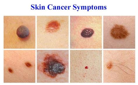 What Are The Symptoms Of Skin Cancer Quora