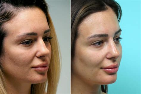 Injections Non Surgical Rhinoplasty Photos Chevy Chase Md Patient