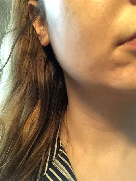 Atrophic Scar After Cortisone Injections Scar Treatments Acne Org Forum