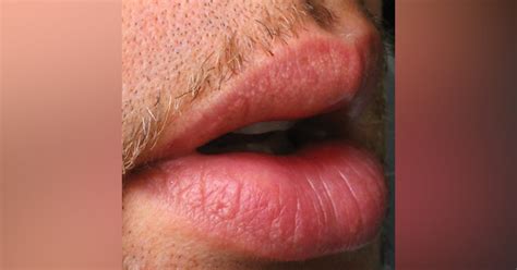 Fordyce Spots On Lips How Does It Look Causes Treatments 40 Off