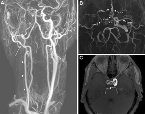 Brain Mri A 3d Contrast Enhanced Mr Angiography Showed A Smaller