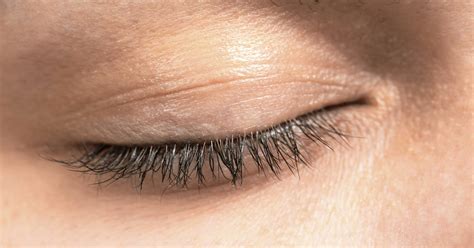 Sagging Eyelids More Common In Some