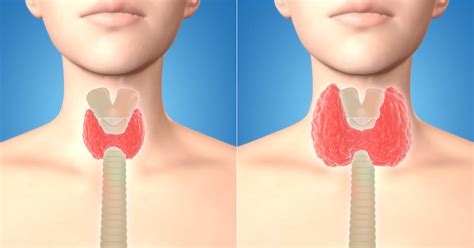 Less common thyroid cancers include medullary thyroid cancer, anaplastic thyroid cancer and thyroid sarcoma or lymphoma. Thyroid Cancer Screening Unnecessary, Study Shows