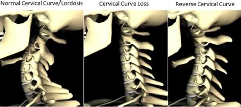 Cervical Curve Loss A Common Cause Of Neck Pain Upper Cervical