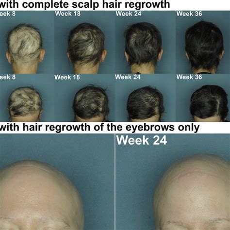 Hair Regrowth With Abatacept Treatment In Patients With Alopecia Areata