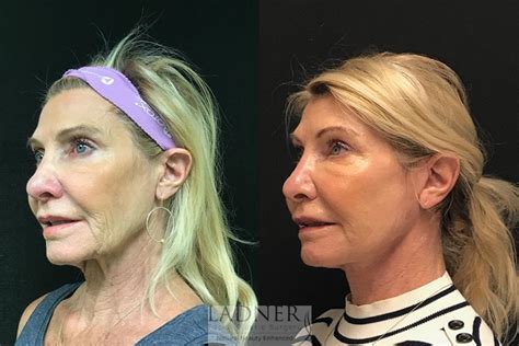 Facelift Neck Lift Results Before And After Hot Sex Picture