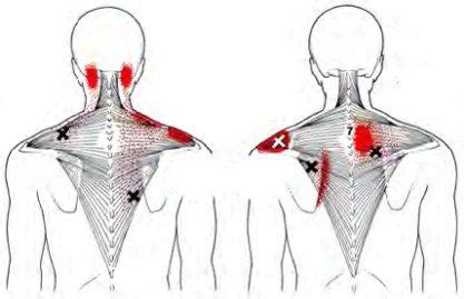 Trapezius - Trigger Point Map | Trigger point therapy, Trigger points