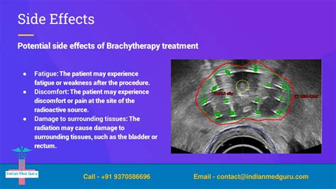 Ppt Brachytherapy Slidesgpt Powerpoint Presentation Free Download Id 12063051