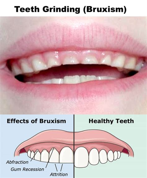 Bruxism Is Teeth Grinding Or Jaw Clenching In Children Kids Dental