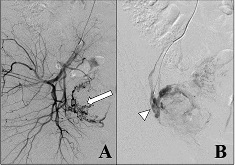 A And B Invasive Angiogram Of Right Internal Iliac Artery Showing