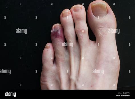 Fractured Toe Hi Res Stock Photography And Images Alamy