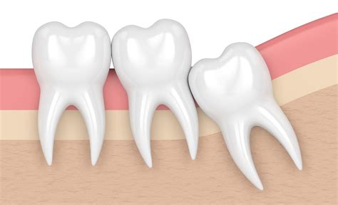 Why Third Molars Often Become Problems Santa Rosa Oral Surgery