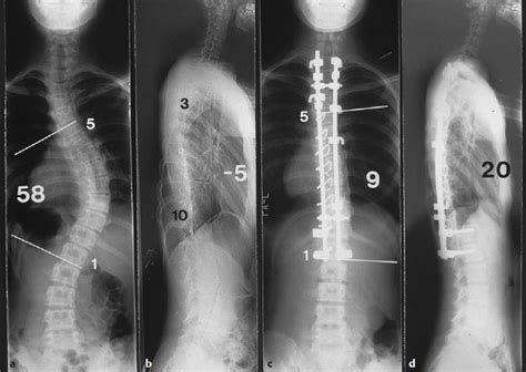 8 Long Term Outcomes Of Operative Management In Adolescent Idiopathic Scoliosis