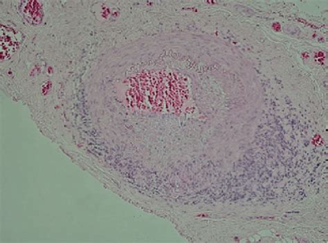 4 Temporal Artery Biopsy From A Patient With Giant Cell Arteritis