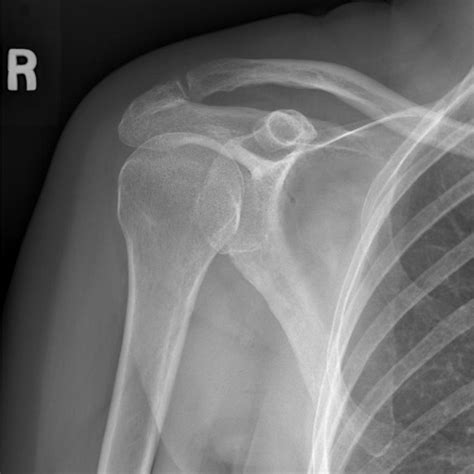 Will The Bone Spur In My Shoulder Cause A Future Rotator Cuff Tear — Mend