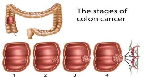 More than likely, their family will be large, too—the more, the merrier! Stages of colon cancer -- what does it mean ...