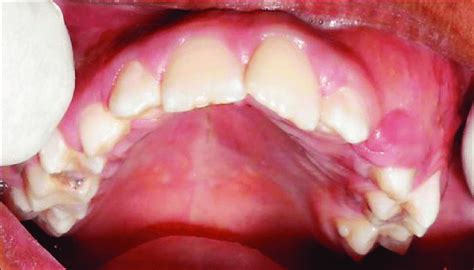 Photograph Showing 3 Cm × 5 Cm Swelling Extending From The Left Upper