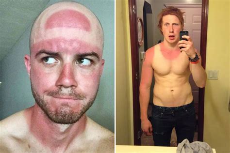 Worlds Worst Sunburn Pics Will Remind You To Top Up The Sunscreen Over