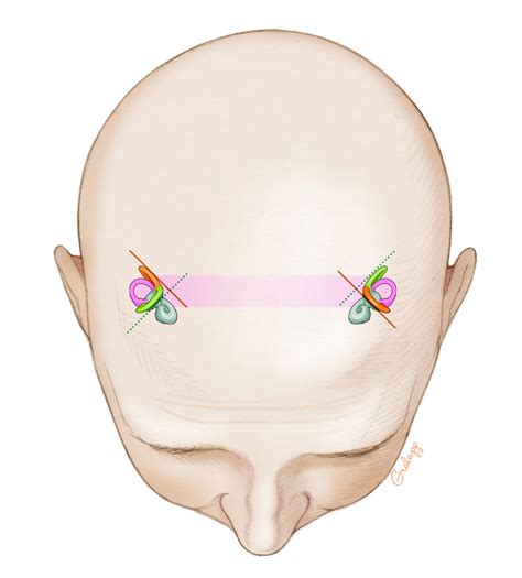 Vestibular System Oto Surgery Atlas