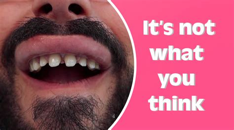 Shaving Down Your Teeth To Get Veneers True Or False