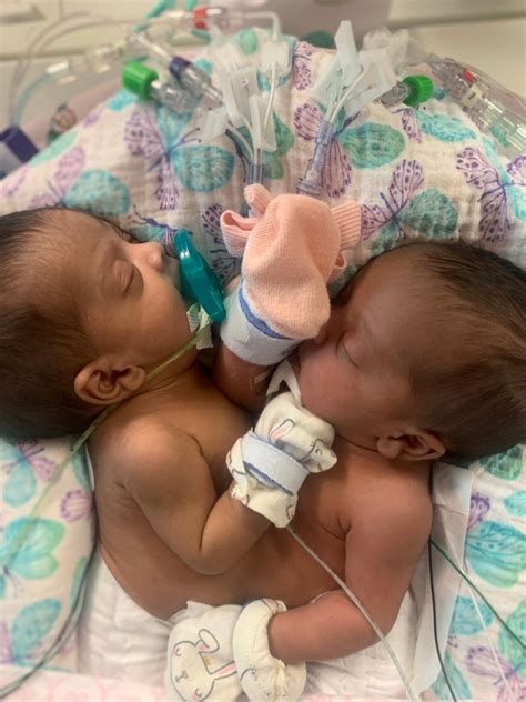 Conjoined Twins Undergo 11 Hour Separation By Team Of 27 Medical Staff