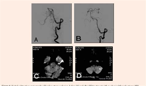 Figure 1 From Mechanical Thrombectomy Of Acute Basilar Artery Occlusion