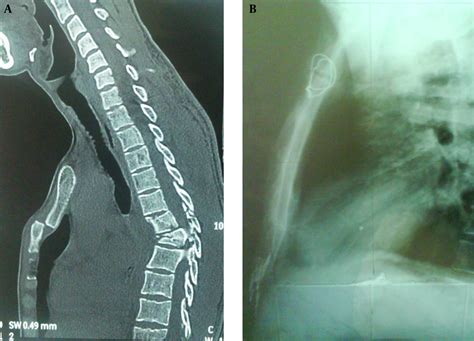 A Sagittal Ct Scan Chest Showed A Displaced Fracture Sternum At The