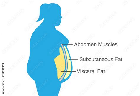 Visceral Fat And Subcutaneous Fat That Accumulate Around Waistline Of