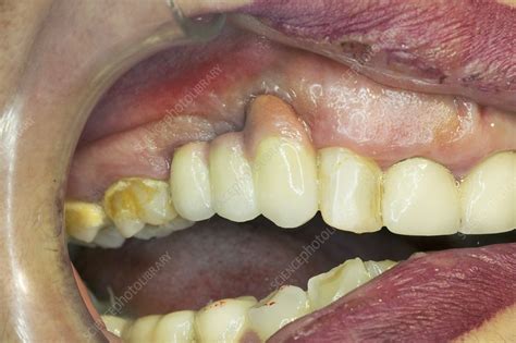 Dental Ceramic Bridge Surgery Stock Image C0474696 Science Photo