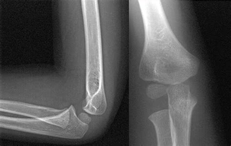 Elbow Anatomy Xray