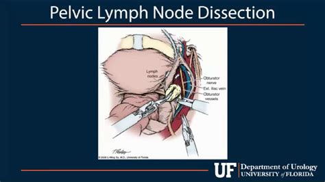 Pelvic Lymph Node Dissection Step By Step Procedure Urology