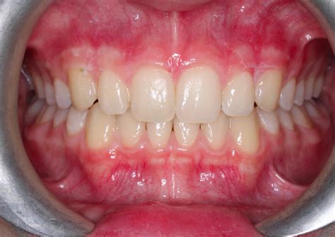 Gum Recession In Orthodontics Black Triangles Orthodontist Vaughan Braces Vaughan