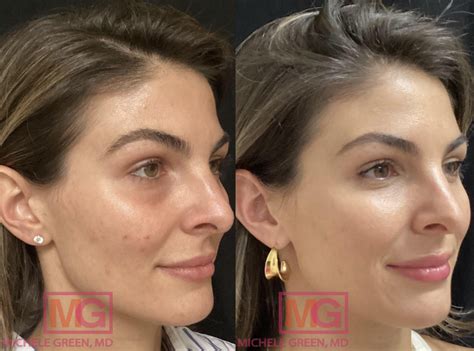 Chemical Peels For Acne Scars And Acne Treatment Acne Scars Nyc