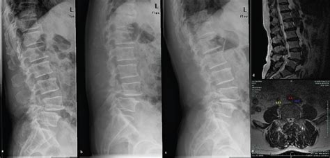 Oblique View Of Lumbar Spine