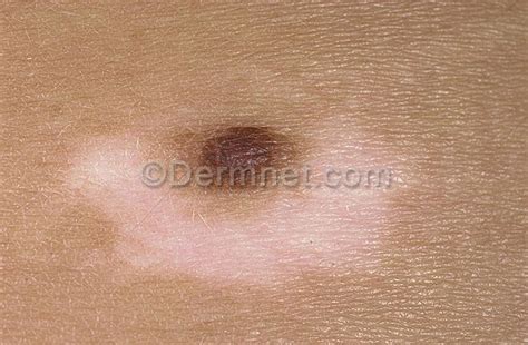 Halo Nevus Photo Skin Disease Pictures
