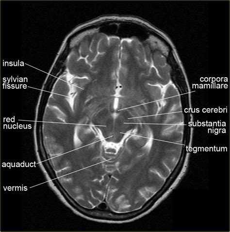 Anatomy Brain Anatomy Radiology Imaging Radiology
