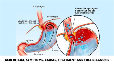 Acid Reflux Main Symptoms Causes Treatment And Full Diagnosis