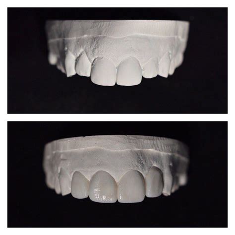 Pin On Ceramident Dental Lab Pictures