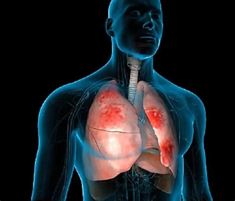 Total Pneumonia Causes Symptoms Treatment And Prevention Diseases