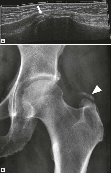 Disorders Of The Groin And Hip Lateral And Posterior Radiology Key