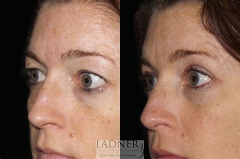 eyelid surgery blepharoplasty before and after pictures case 54 denver co ladner facial