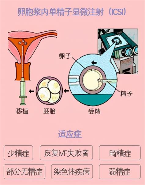 胚胎受精解讀：2pn、0pn、1pn有什區別？ 每日頭條