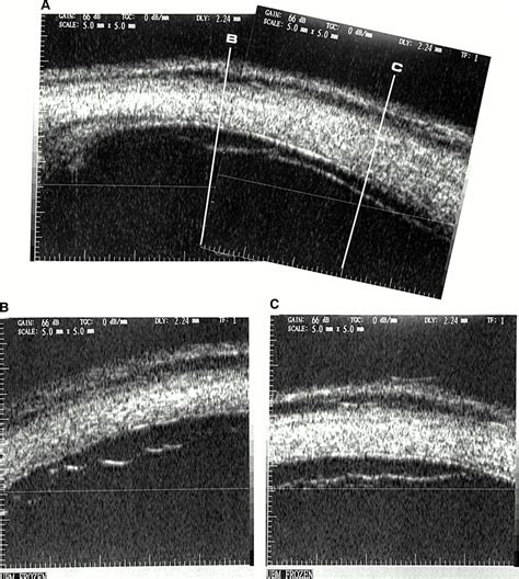Ultrasound Biomicroscopy Of The Peripheral Retina And The Ciliary Body