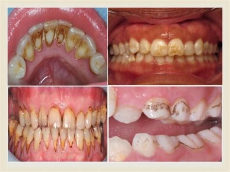 Teeth Discoloration Causes In Adults And Children Explained