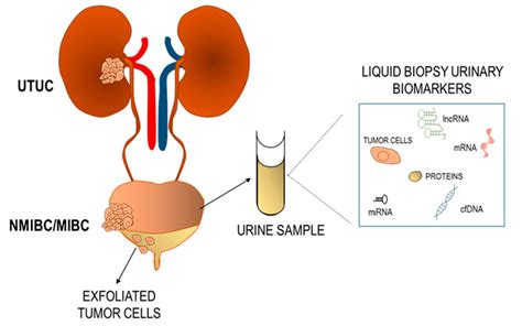 Jpm Free Full Text Liquid Biopsy Biomarkers In Urine A Route
